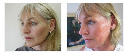 before and after Dermaroller therapy