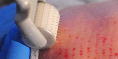 ABOUT DERMAROLLER THERAPY Dermaroller therapy is also variously known micro-needling, medical needling and skin needling. The Dermaroller devices are the only US FDA, CE approved and German patented devices whose efficacy has been proven by scientific studies and medical schools all over the world. The Dermaroller concept is based on two main functions a) Stimulation of the body's own production of collagen (collagen induction therapy) b) Increased penetration of active substances into the skin, for example serums (transderamal delivery) COLLAGEN INDUCTION THERAPY The principle behind CIT is simple: to stimulate the body's own production of collagen (neocollagenisis). The device is a surgical stainless steel roller comprised of dozens of fine needles which are used to puncture the skin and intensely stimulate the production of collagen. Thousands of tiny punctures are produced by rolling the device across the treated area, and these become the focal point for the body to produce its own collagen. TRANSDERMAL DELIVERY A large percentage of the cost of many face creams and serums is wasted by the active ingredient not reaching the layers of skin where it is needed. The home care Dermaroller is studded with over 150 extremely fine needles. Its use is uncomplicated and pain free. The short needles (0.15mm) only push the uppermost scales aside and do not puncture the deeper skin. The needles transport the active substances on the surface through the epidermal barrier into deeper skin layers. Both the home care and in clinic Dermaroller (where applicable) treatments increase the absorption of biological products.