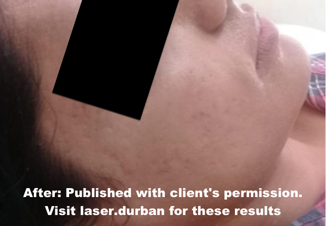 scar reduction after